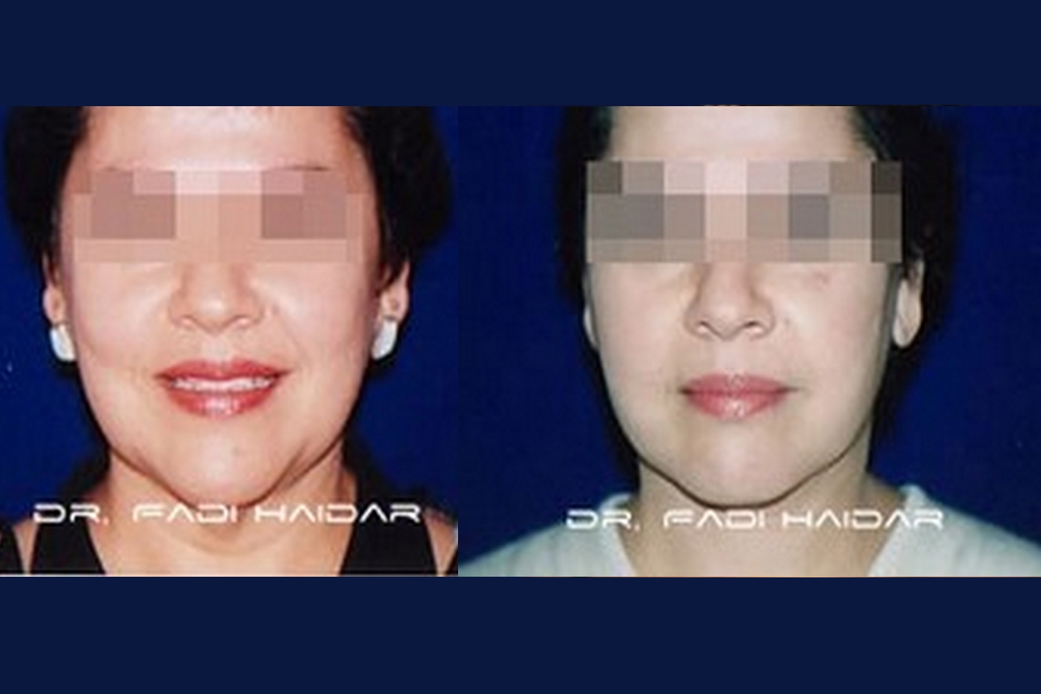 Lifting Facial 1