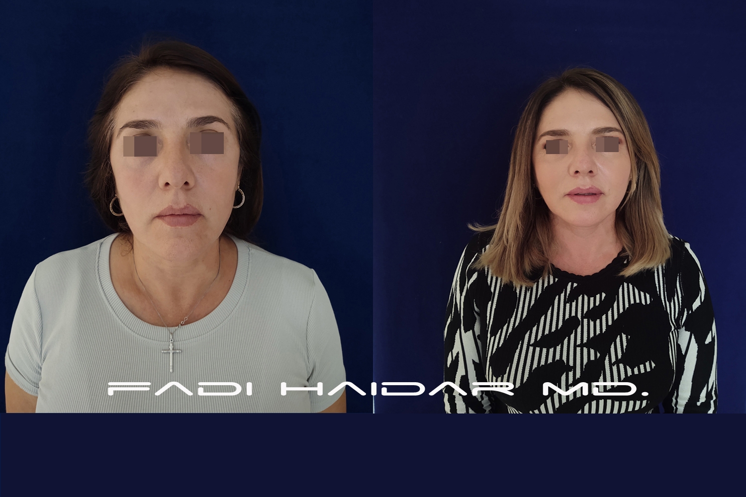 Lifting Facial 2