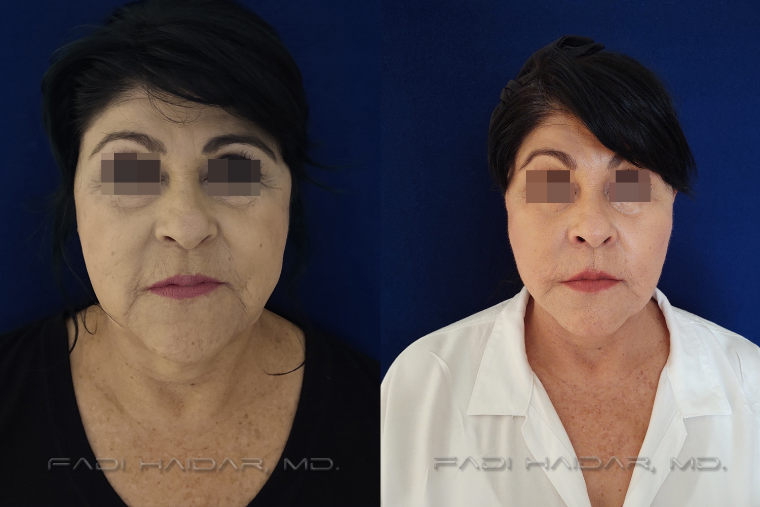 Lifting Facial 3