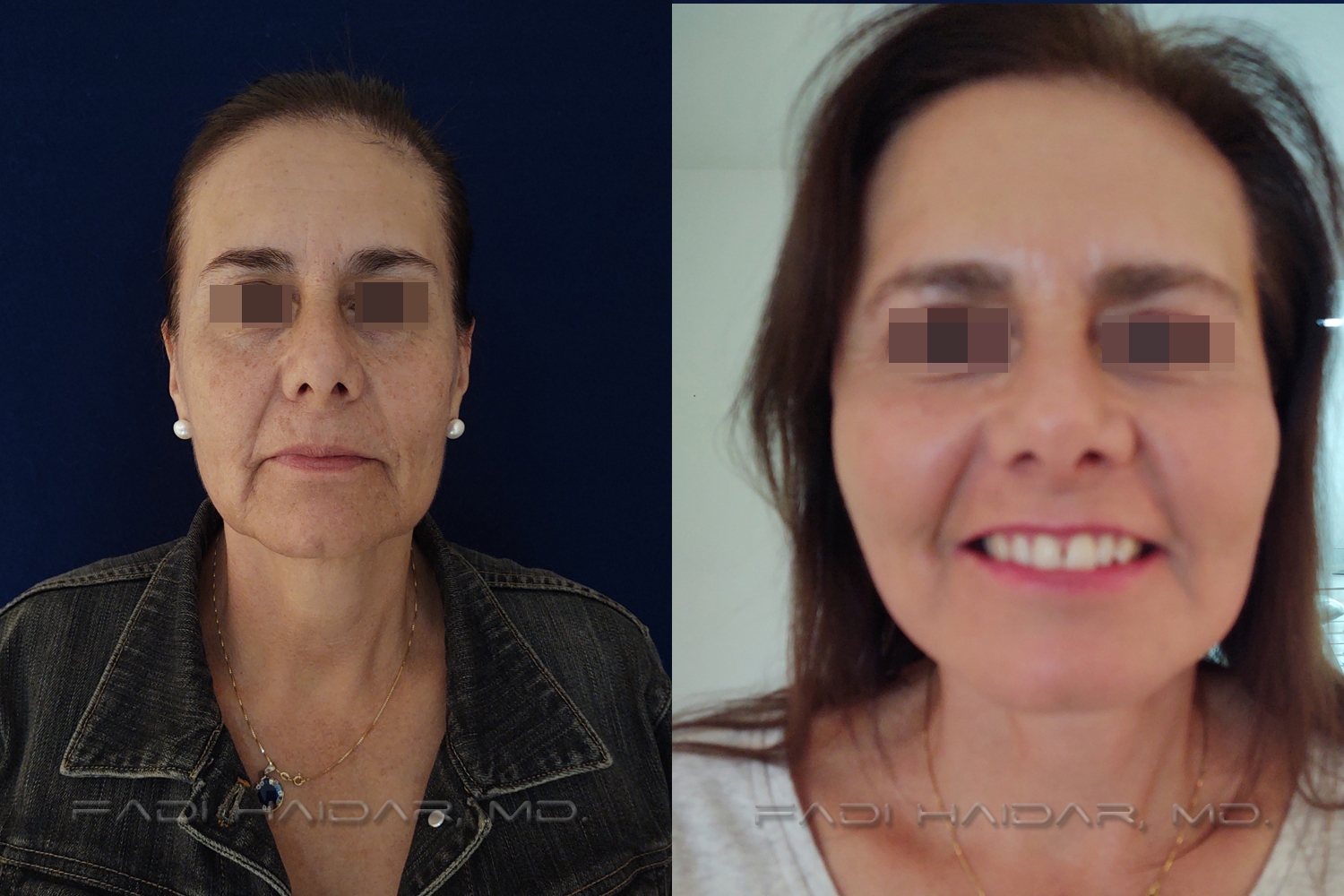 Lifting Facial 4