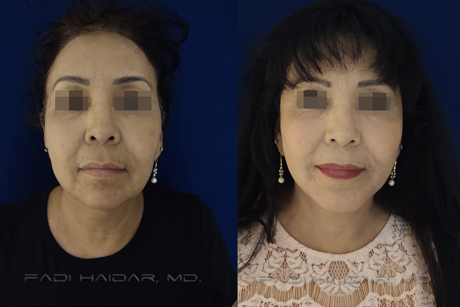 Lifting Facial 5