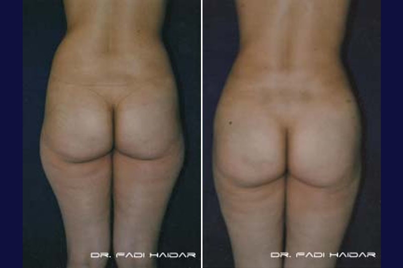 Lipoescultura 8