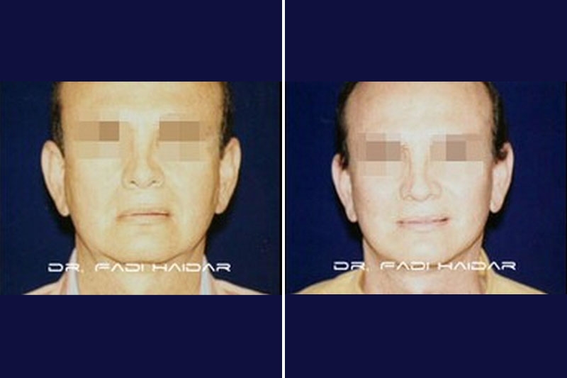 Lifting Facial 6