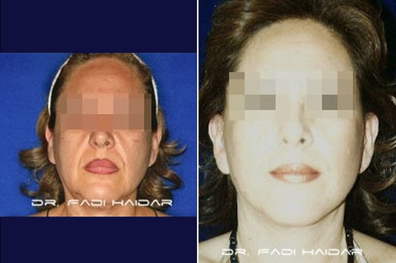 Lifting Facial 7