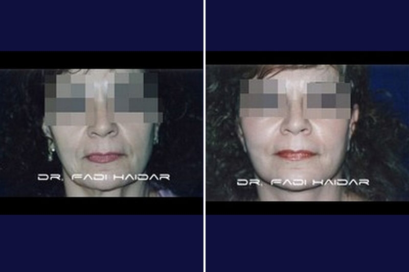 Lifting Facial 9