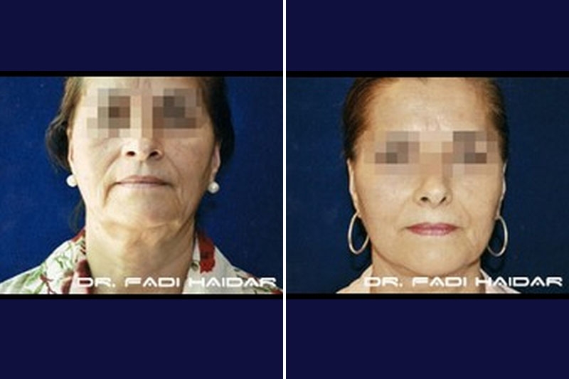Lifting Facial 8
