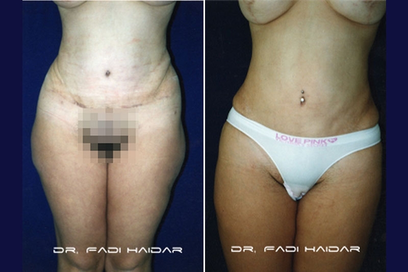 Abdominoplastia Cirugía de Abdomen 3