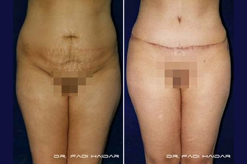 Abdominoplastia Cirugía de Abdomen 6