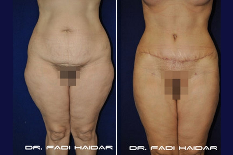 Abdominoplastia Cirugía de Abdomen 8