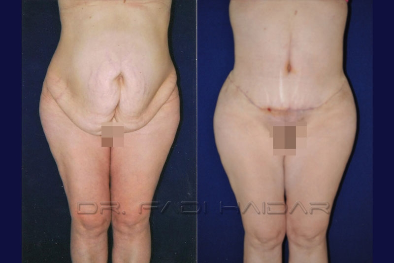 Abdominoplastia Cirugía de Abdomen 10