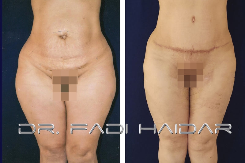 Abdominoplastia Cirugía de Abdomen 11
