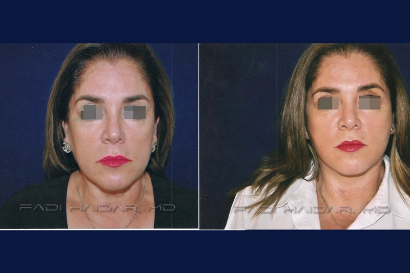 Lifting Facial 11