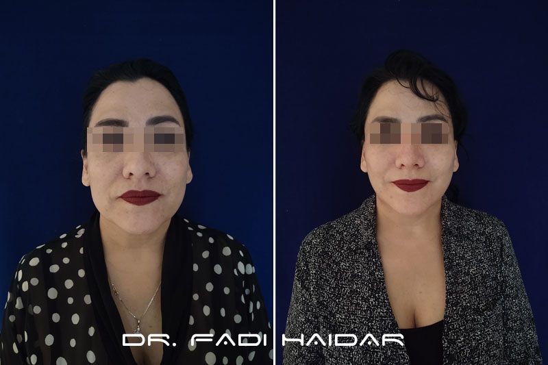 Lifting Facial 10