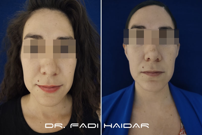 Implantes Faciales 3