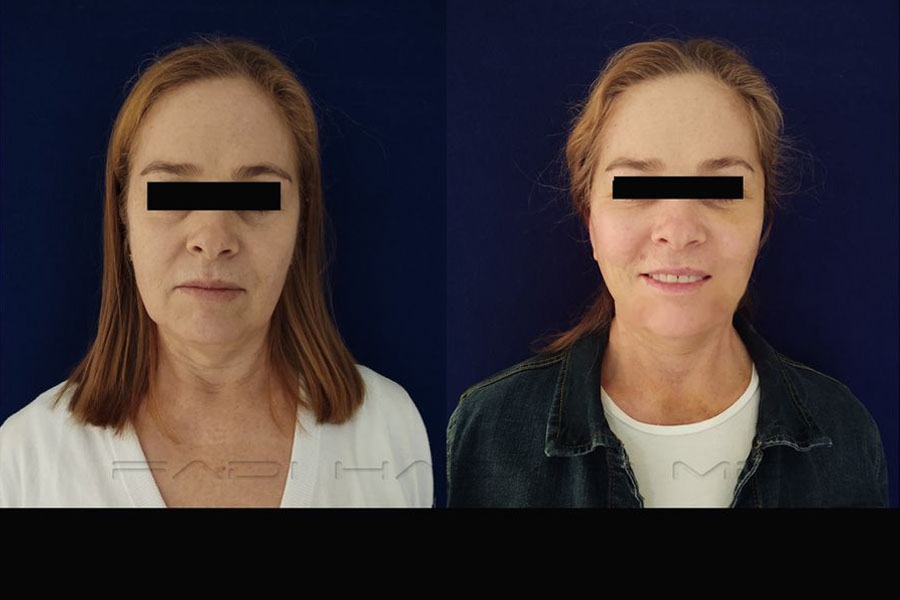 Lifting Facial 12