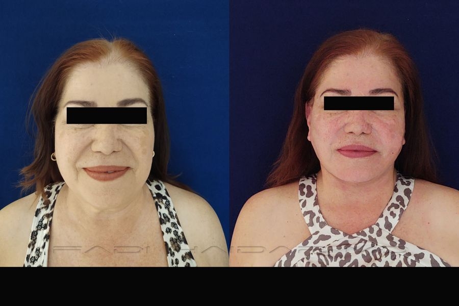 Lifting Facial 13