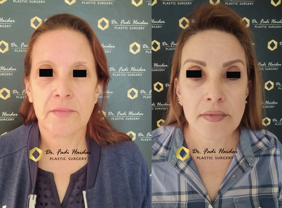 lifting facial guadalajara