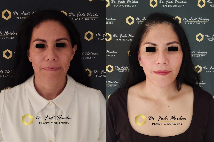 Lifting facial Guadalajara