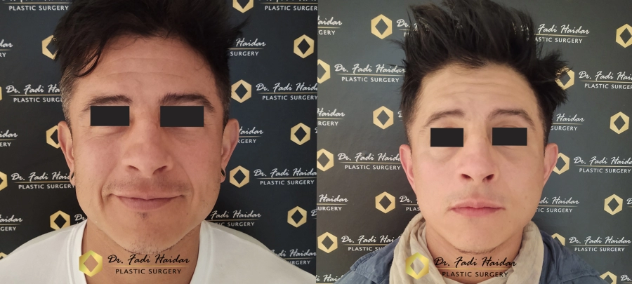 Lifting Facial en Guadalajara
