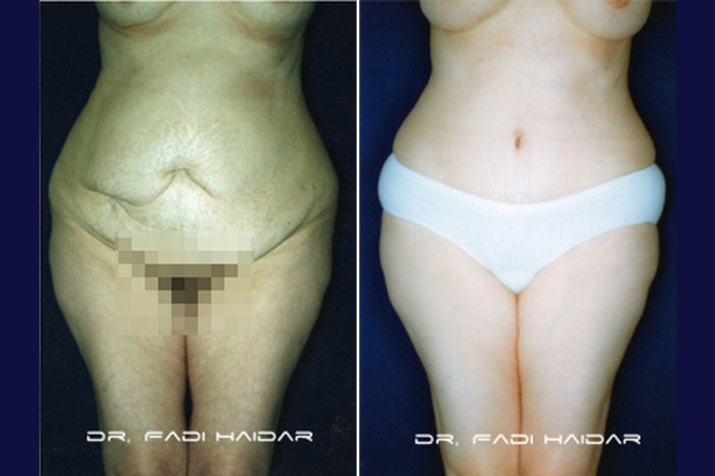 Abdominoplastia Cirugía de Abdomen 2