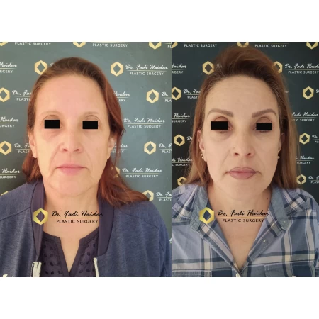 lifting facial guadalajara