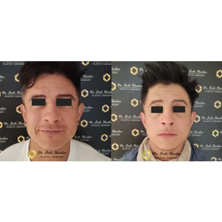 Lifting Facial en Guadalajara
