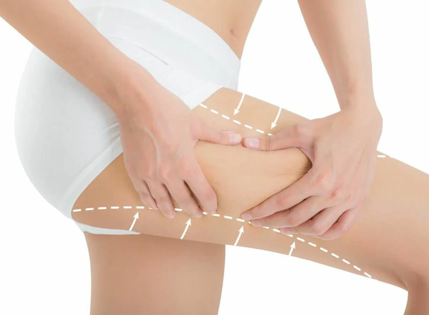 Mesoterapia - Tratamiento Corporal